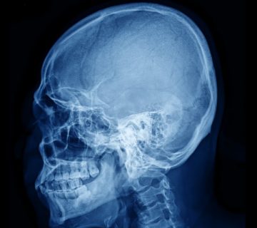 Neoplasia base del craneo Dra Monserrath Acosta