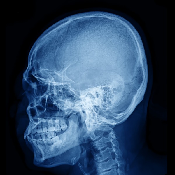 Neoplasia base del craneo Dra Monserrath Acosta