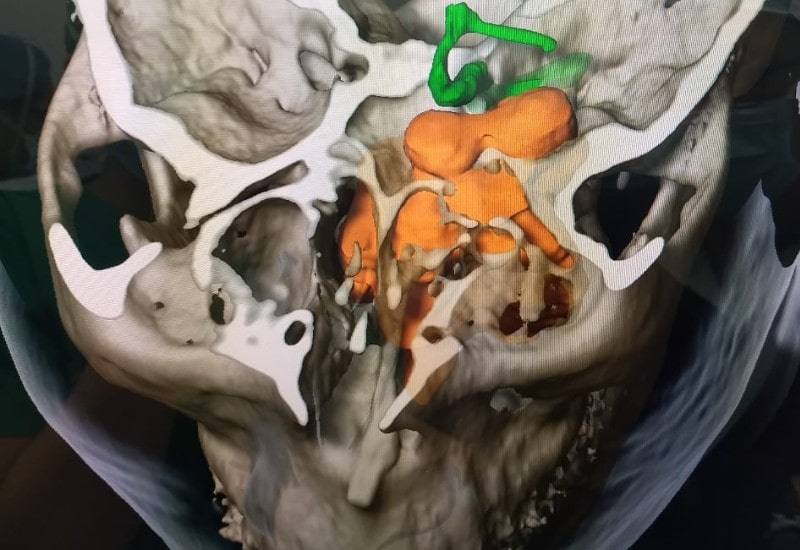 Neoplasia de base de craneo