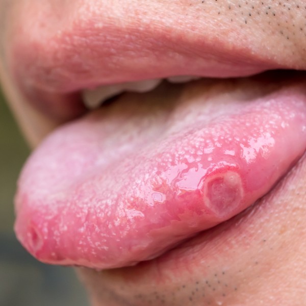 Neoplasia de tejidos blandos Dra Monserrath Acosta